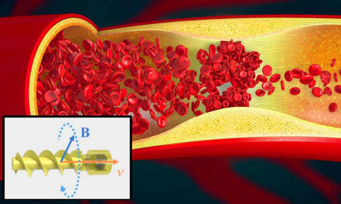 Picture 1 of Spiral robot swims in blood vessels to break blood clots