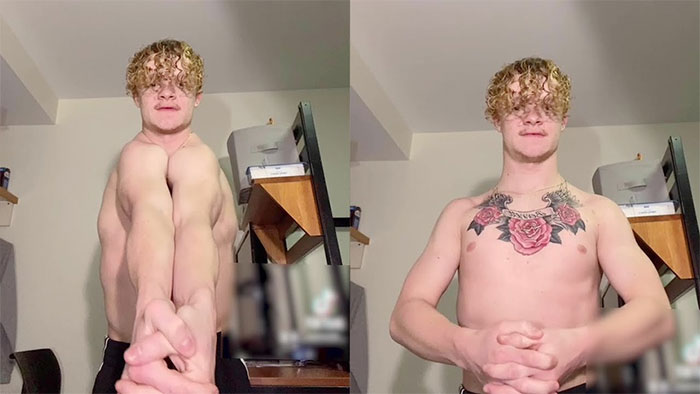 Picture 1 of Strange disease that causes sufferers to fold their shoulders