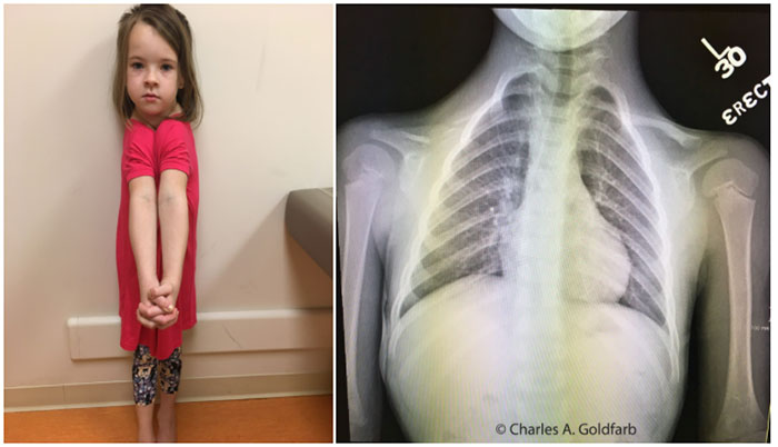 Picture 3 of Strange disease that causes sufferers to fold their shoulders
