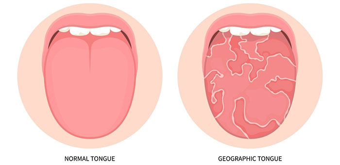 Picture 2 of Strange Features of the Human Tongue: Tentacle Tongue, Map Tongue, and Fissured Tongue