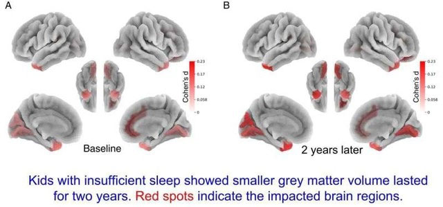 The American College of Medicine found that children who do not sleep for 9 hours a night have less gray matter Picture 1