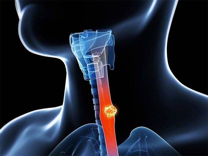 The culprits that cause esophageal cancer you didn't expect Picture 1