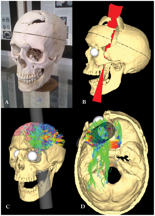 The horror of the iron bar that pierced the skull gave birth to modern neuroscience Picture 3