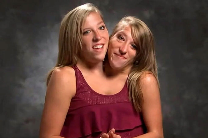 The most famous conjoined twins: Sharing the same body for 34 years, their current life is surprising Picture 3