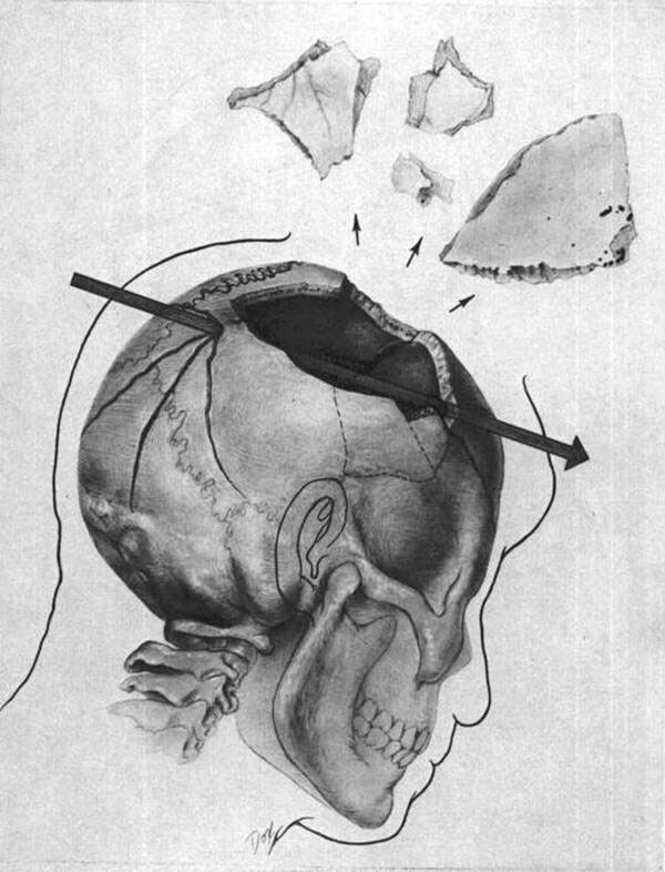 Picture 2 of The mystery of the disappearing brain of former US President Kennedy