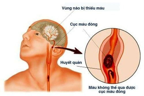 Picture 1 of Things to know about cerebral infarction