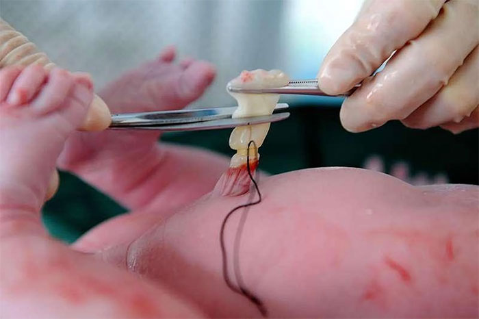 Picture 3 of Things to know about stem cells from umbilical cord blood
