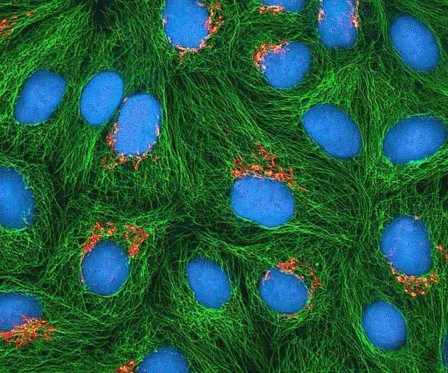 This cancer cell has been nurtured for 70 years, the volume alone is more than 50 million tons Picture 2