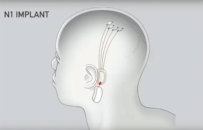Picture 1 of Thousands of people line up to have brain chips implanted
