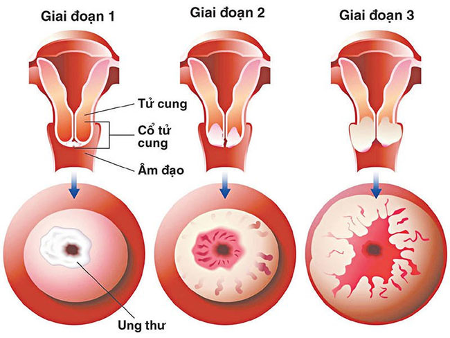 Picture 10 of Top 14 most dangerous cancers today