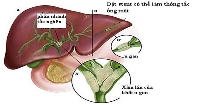 Picture 13 of Top 14 most dangerous cancers today