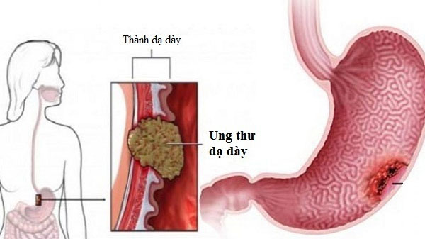 Picture 14 of Top 14 most dangerous cancers today
