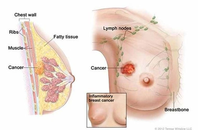 Picture 5 of Top 14 most dangerous cancers today