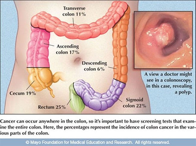 Picture 6 of Top 14 most dangerous cancers today