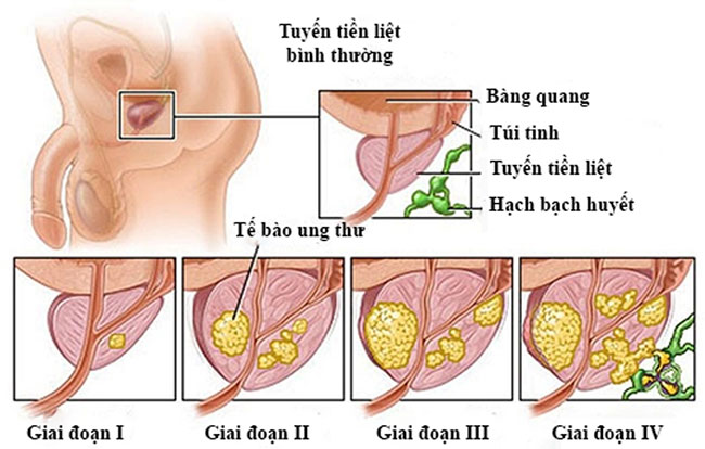 Picture 7 of Top 14 most dangerous cancers today