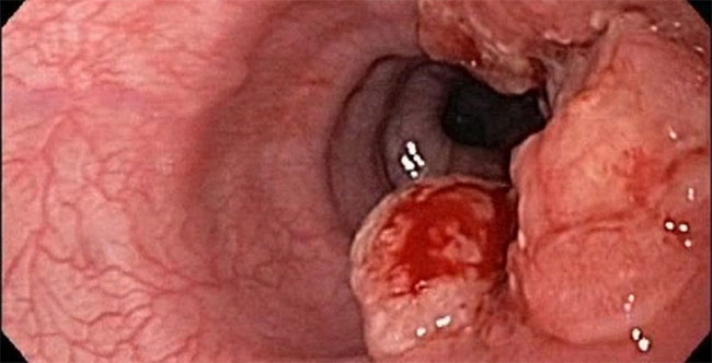 Picture 9 of Top 14 most dangerous cancers today