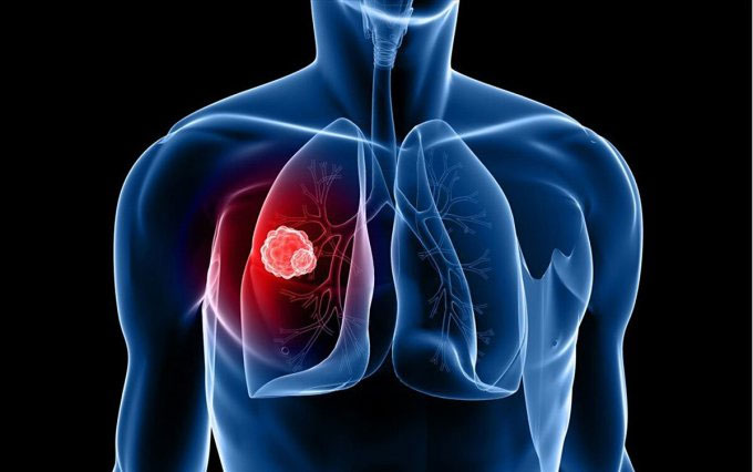 Picture 1 of US approves lung cancer drug costing 780,000 USD