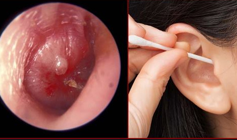 What is normal earwax? Picture 1