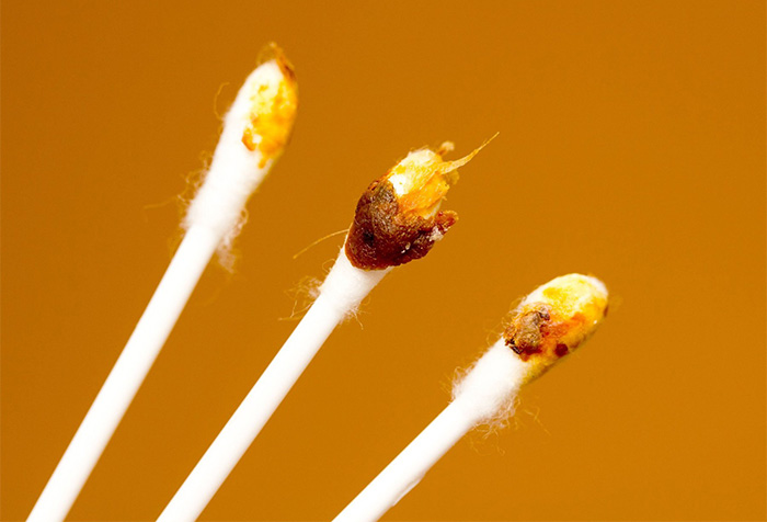What is normal earwax? Picture 3