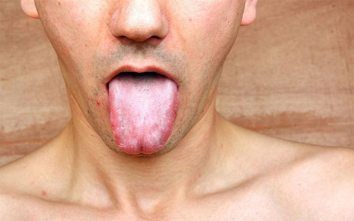 Picture 1 of What is syphilis?