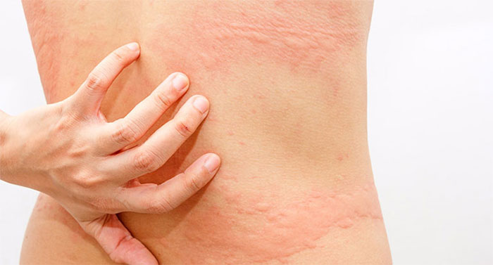 Picture 2 of What should I do when my child has a red rash like a mosquito bite?