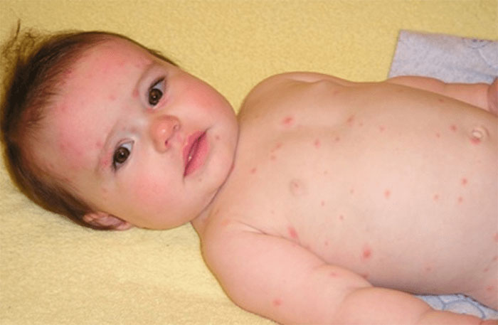 Picture 3 of What should I do when my child has a red rash like a mosquito bite?