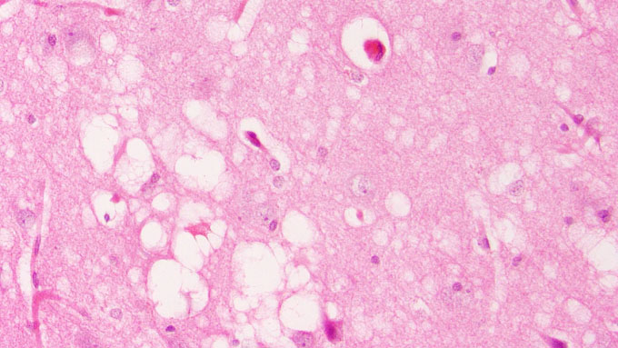 Which infectious diseases have a mortality rate close to 100%? Picture 1