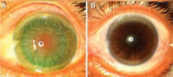 Picture 2 of Why can some species of cobras spray venom precisely into the victim's eyes?