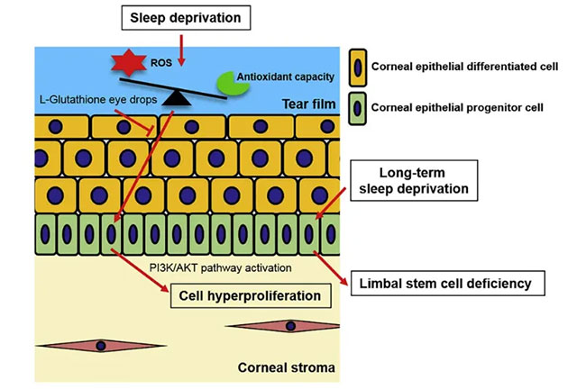 Picture 2 of Why does sleep loss make our eyes itchy?