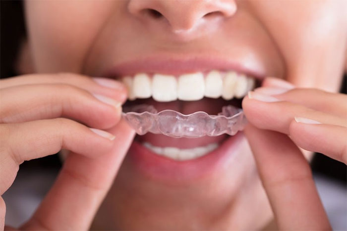 Picture 2 of Why many people grind their teeth while sleeping
