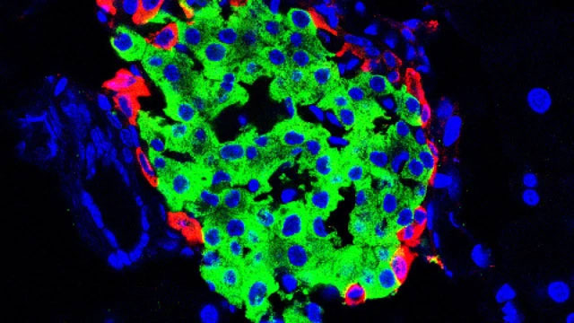 Picture 5 of World's first patient cured of diabetes thanks to miraculous stem cells