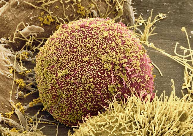 Picture 1 of World's first woman cured of HIV thanks to stem cell transplant