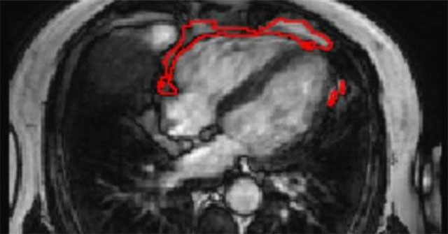 AI technology helps measure pericardial fat levels