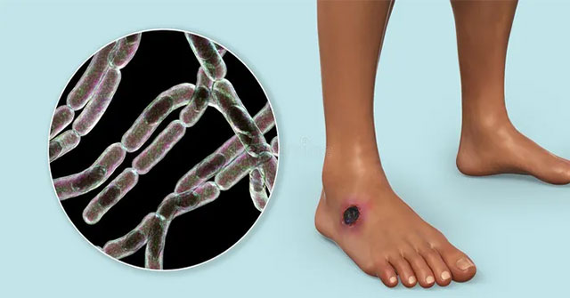 Anthrax toxin could be key to new pain therapies