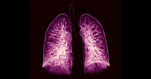 Artificial intelligence can diagnose lung cancer up to a year early