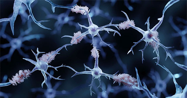 Blood transfusion opens new hope in the treatment of Alzheimer's disease