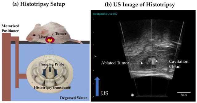 Breakthrough: An ultrasound technique helps destroy liver cancer tumors without surgery