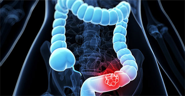 Breakthrough in research on early detection of bowel cancer tumors