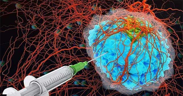 Chinese scientists develop hydrogel to help burn tumors in the body
