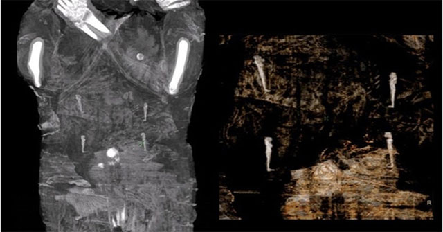 Decipher the mystery of how to preserve the fetus in a 2,000-year-old Egyptian mummy