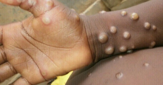 Detecting the second strain of monkeypox virus that is spreading fast