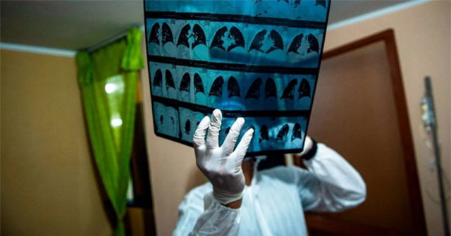 Discovering a gene that doubles the risk of lung failure and death from Covid-19