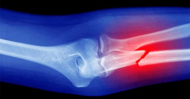Experimental study using vaccine technology to heal bones