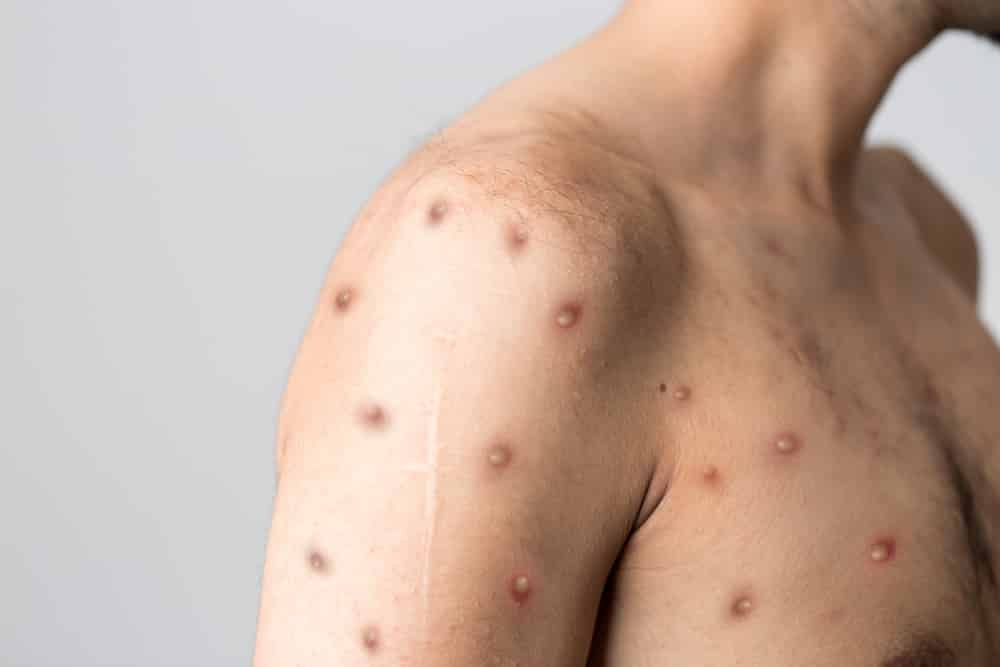 Expert: Monkeypox epidemic can be transmitted through 2 large gay parties in Europe -