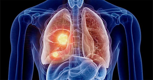 Find out the reason why more and more young people get cancer