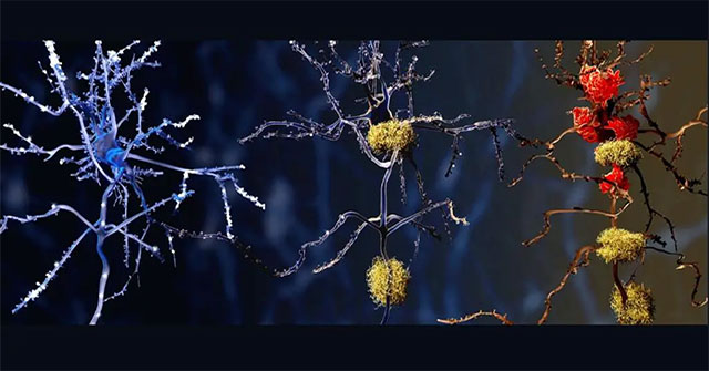 Finding a new potential culprit of Alzheimer's disease