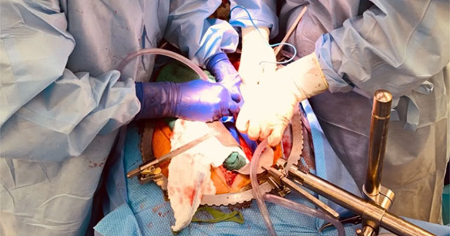 First successful pig kidney transplant for brain dead people