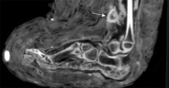 For the first time, a bandage wound was discovered in an Egyptian mummy