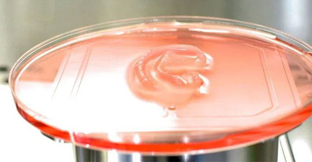 For the first time in the world: 3D printed human ear, successfully implanted in a girl