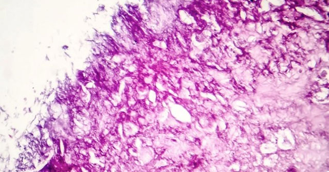 Found a way to kill 99% of cancer cells